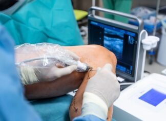 Mes de lucha contra las várices: Una dolencia que en su mayoría afecta a mujeres VARICES